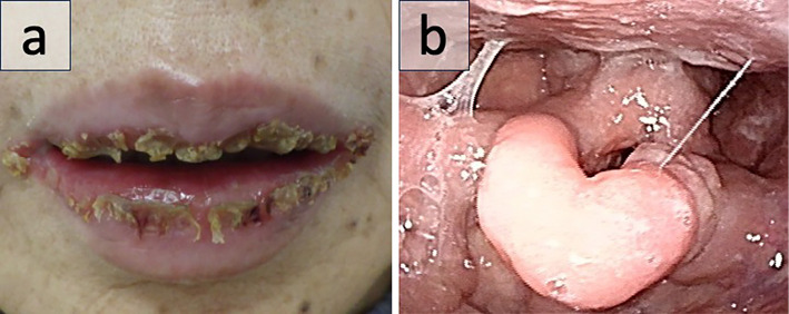 Laryngeal Web Caused by Mucous Membrane Pemphigoid.