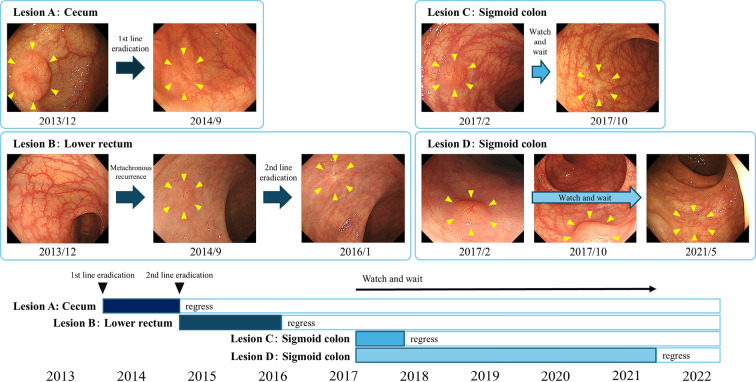 Helicobacter pylori-positive Colorectal MALT Lymphoma with Repeated Metachronous Recurrence after a Complete Response to Eradication Therapy and Regression after a Watch-and-wait Strategy.