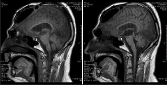 A customized large single-piece bifrontal implant for post-craniectomy defect reconstruction: A case study.