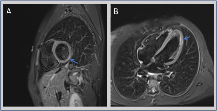 From gut to heart: Salmonella gastroenteritis complicated by myocarditis: a case report.