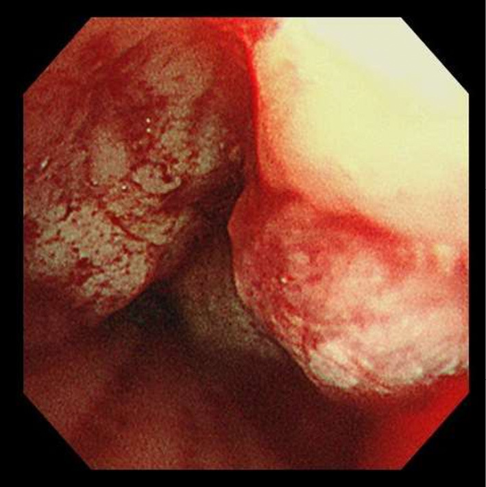Post-Transplant Lymphoproliferative Disorder Which Developed 45 Years After Kidney Transplantation.