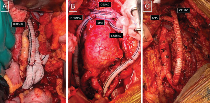 Hybrid Repair for Complex Thoracoabdominal and Pararenal Aortic Aneurysms in High-Risk Patients: A Case Series.