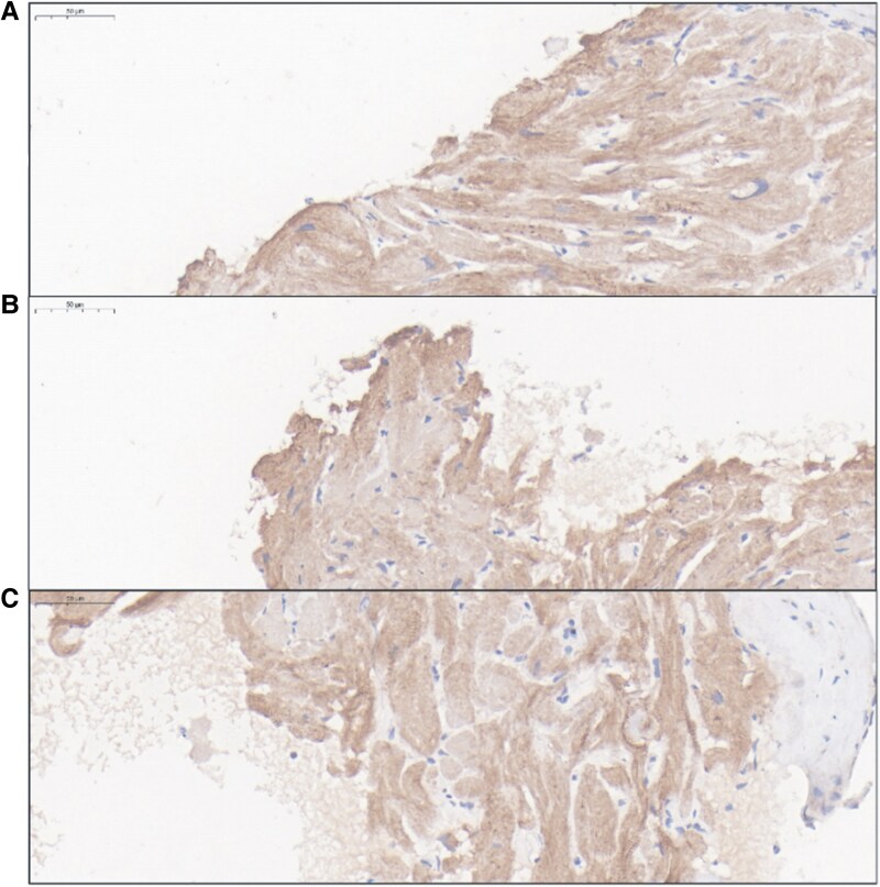 Restrictive cardiomyopathy due to new mutation in the ACTN2 gene: a case report.