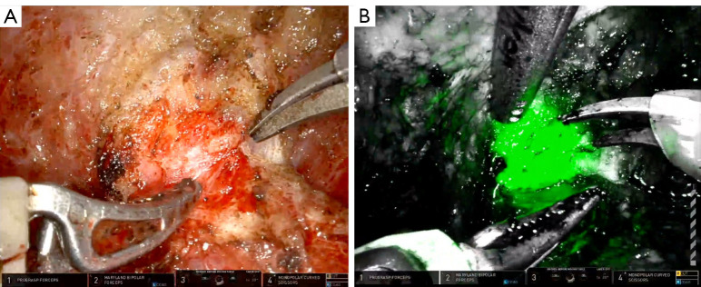 A review of management options for vesicourethral anastomotic stenosis and the emergence of robotic reconstruction.