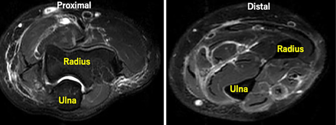 Restricted Movement Associated with Unilateral Diffuse Fasciitis.