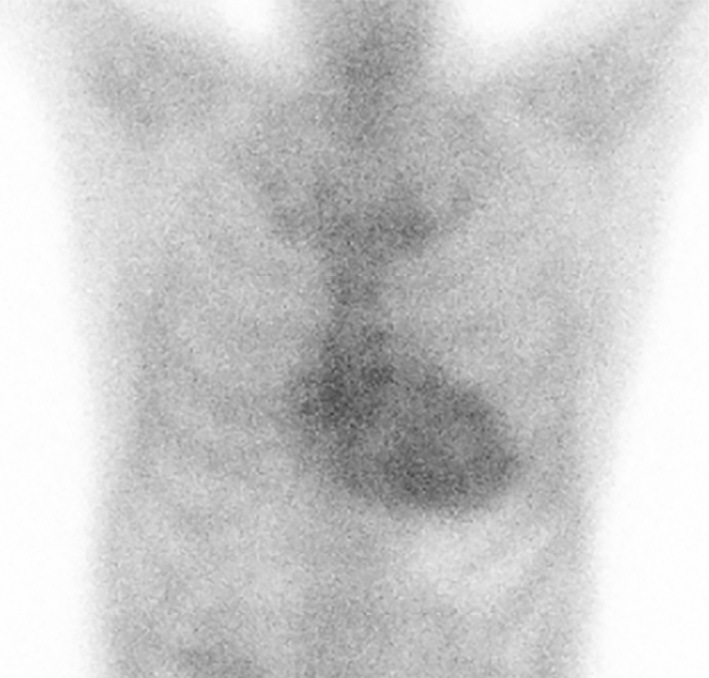 Concurrent Therapy for Immunoglobulin Light Chain Cardiac Amyloidosis and Transthyretin Cardiac Amyloidosis.
