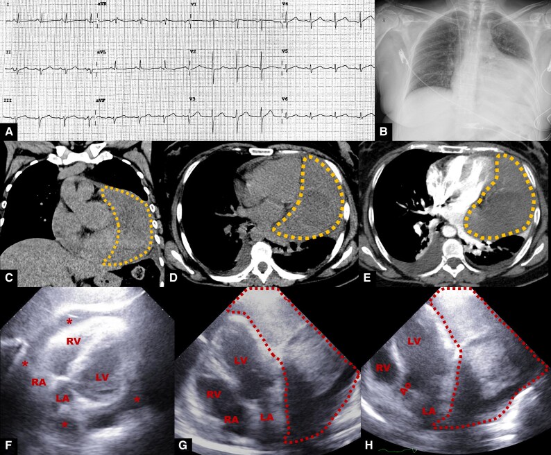 Intrapericardial localization of solitary fibrous tumour: a case report.