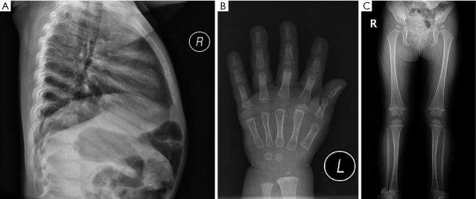 Noonan syndrome with <i>PTPN11</i> gene variant presenting as isolated short stature: a case report.