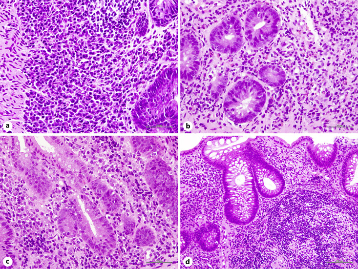 Histological Predictors for Therapeutic Response to Integrin Inhibitors in Patients with Ulcerative Colitis.