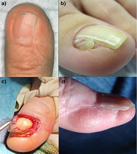 Complications in nail surgery and prevention strategies: a comprehensive review.