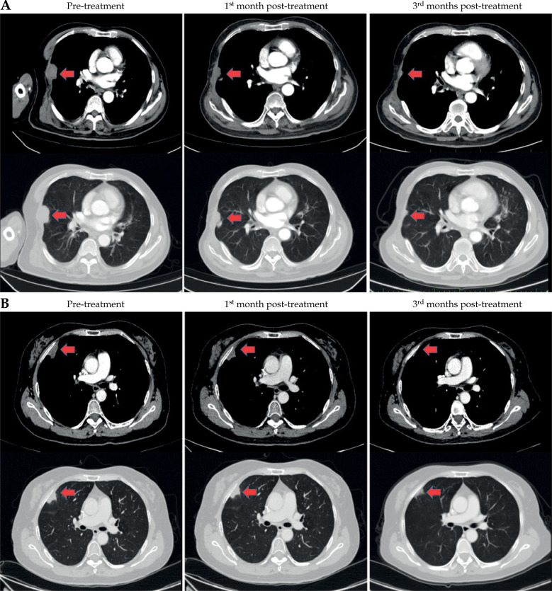 Safety and efficacy of iridium-192 high-dose-rate interstitial brachytherapy for pleural and chest wall tumours: preliminary results.