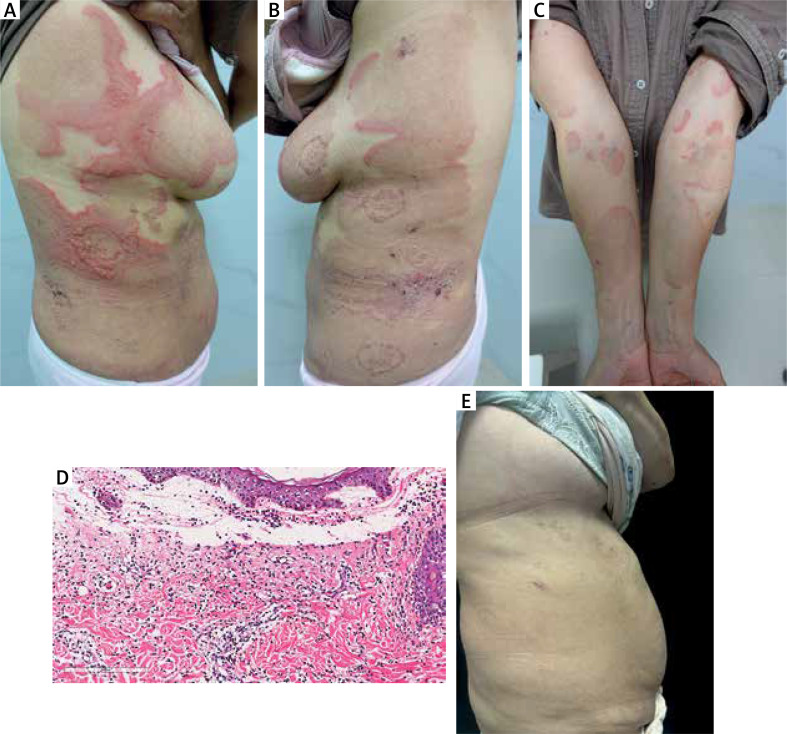 A rare case of bullous eosinophilic annular erythema.