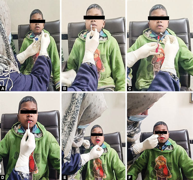 Cheiloscopy-Your Identity, Our Indicator: A Cross-sectional Study to Evaluate the Relationship between Lip Prints and Dental Caries in Children of Jammu Province.