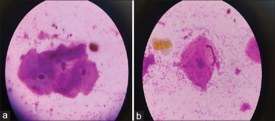 A Clinico-etiological study of women in reproductive age group presenting with vaginal discharge.