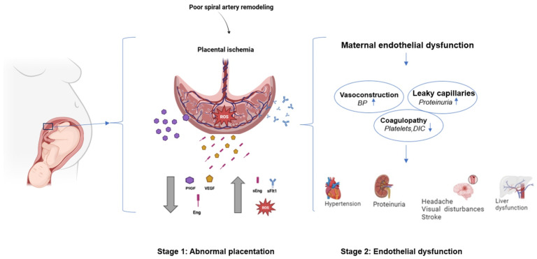Understanding Preeclampsia: Cardiovascular Pathophysiology, Histopathological Insights and Molecular Biomarkers.