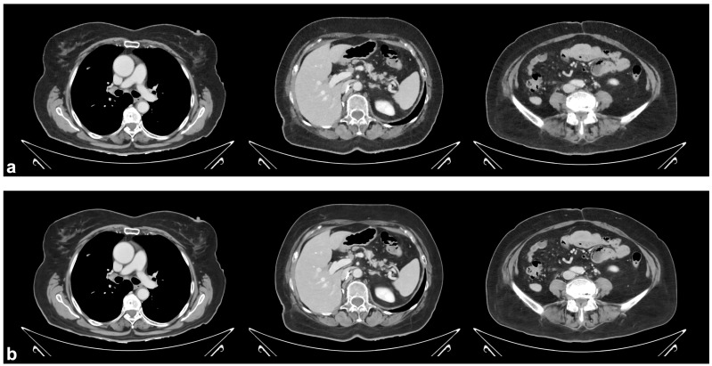 Performance of a Deep Learning Reconstruction Method on Clinical Chest-Abdomen-Pelvis Scans from a Dual-Layer Detector CT System.
