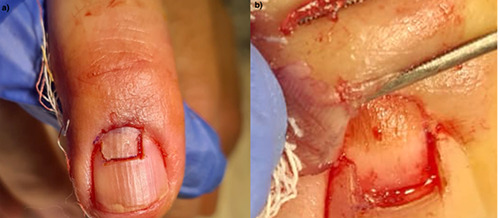 Complications in nail surgery and prevention strategies: a comprehensive review.