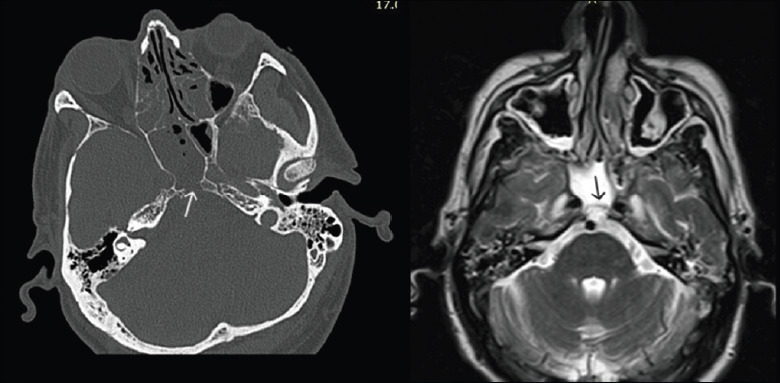 Ecchordosis physaliphora of the clivus: a case series and narrative review of the literature.