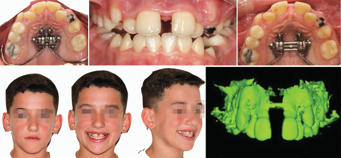 Skeletal Anchorage in Class III Malocclusion in Early Adolescence.