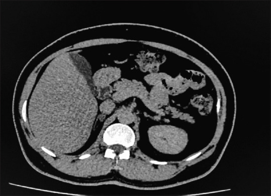 Recurrent hypokalemia induced by primary aldosteronism due to unilateral adrenal adenoma. A case report.