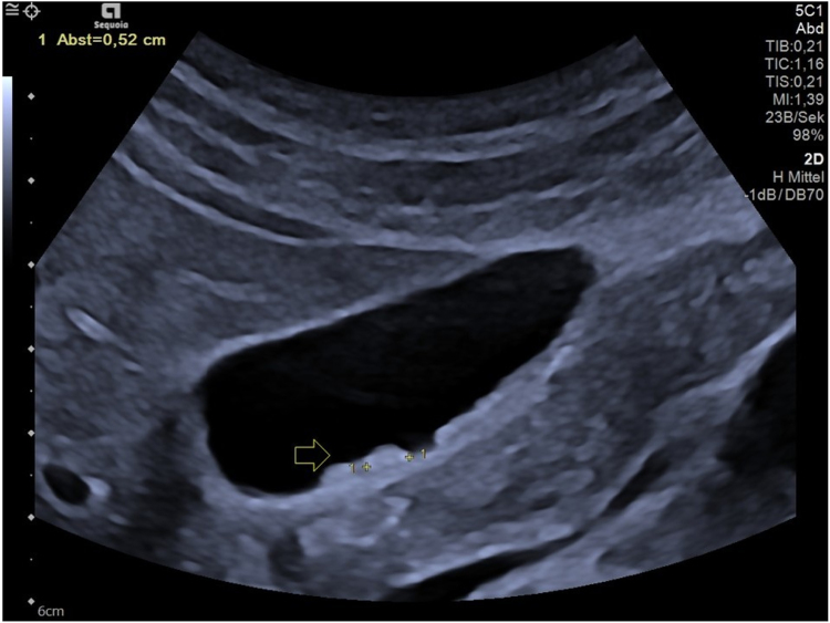 Gall bladder sludge and biliary pseudolithiasis as rare complications of ceftriaxone therapy in adult patients - A case report including sonographic workup.