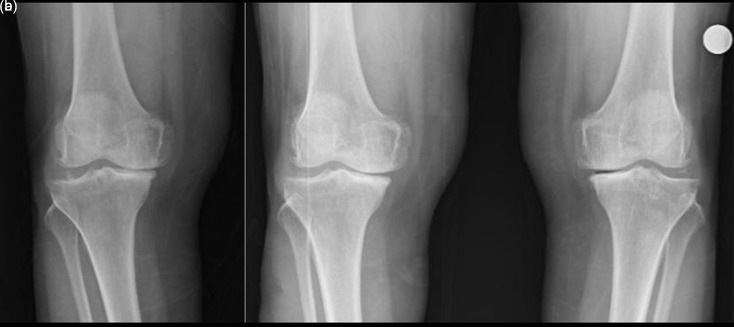 Impact of single-leg versus double-leg weight-bearing radiographs on surgical decision-making in knee osteoarthritis.