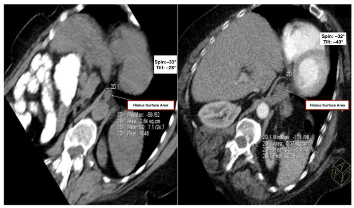 Association Between Thoracic Kyphosis and Hiatal Enlargement: A CT-Based Study Interpreted in Light of GERD-Linked Morphological Markers.