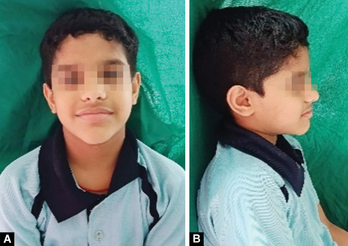 Early Intervention for Malocclusion: Role of Myobrace in Children Aged 6-10 Years.