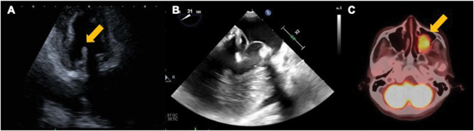 Recurrent Nonbacterial Thrombotic Endocarditis after Vegetectomy of Bioprosthetic Mitral Valve.