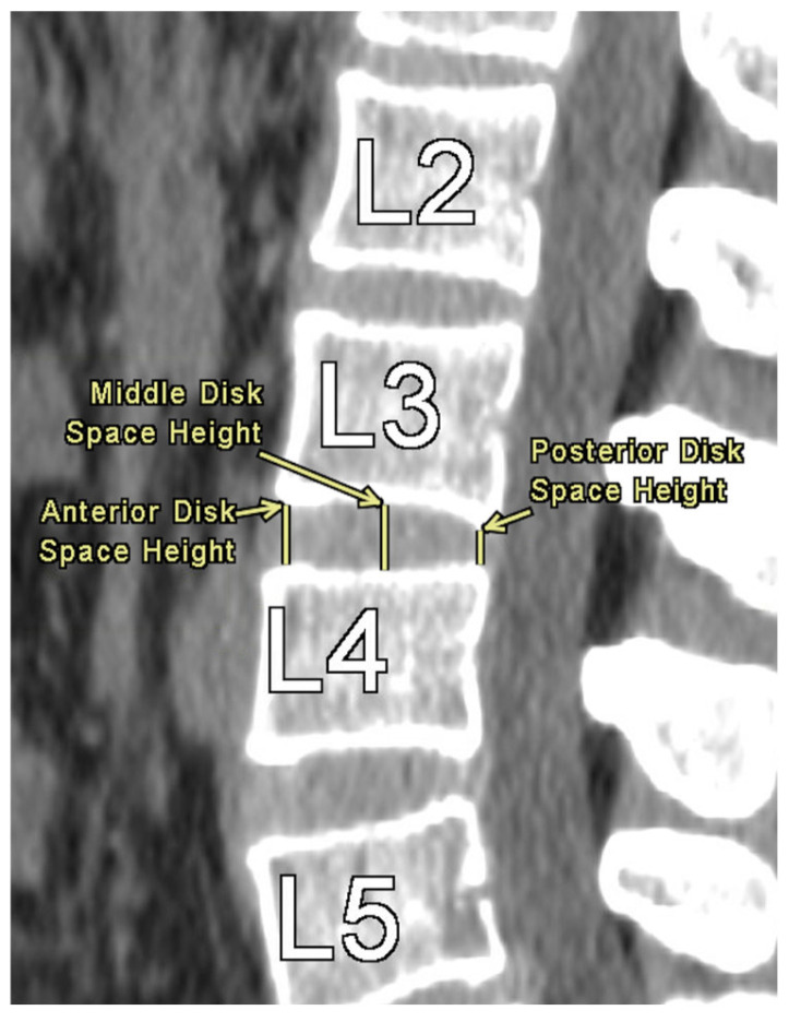 Correlations of Lumbar Interspinous Distance with Neuroforaminal Dimensions, Disc Space Height, and Patient Demographic Factors.