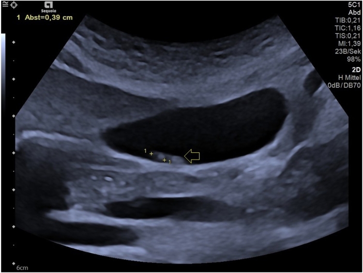 Gall bladder sludge and biliary pseudolithiasis as rare complications of ceftriaxone therapy in adult patients - A case report including sonographic workup.
