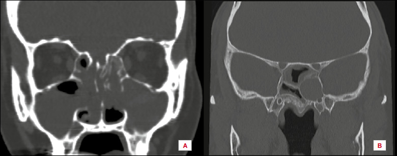 Should computed tomography be used in the evaluation of biologic therapies for severe chronic rhinosinusitis with nasal polyps?
