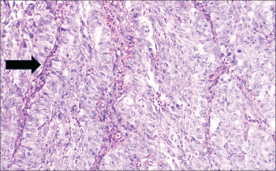 Sinonasal carcinoma: A rare case report.