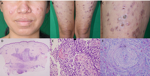Lucio phenomenon: a case report on an overlooked reaction in lepromatous leprosy.