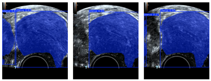 Learning Guided Binary PSO Algorithm for Feature Selection and Reconstruction of Ultrasound Contrast Images in Endometrial Region Detection.