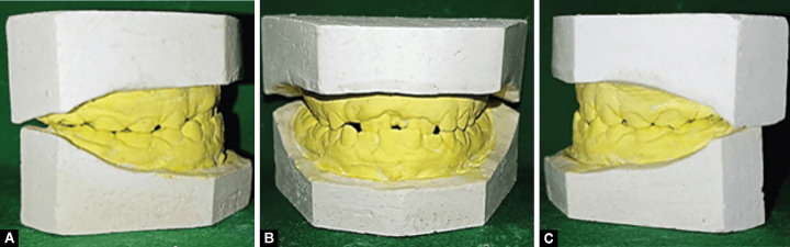 Early Intervention for Malocclusion: Role of Myobrace in Children Aged 6-10 Years.