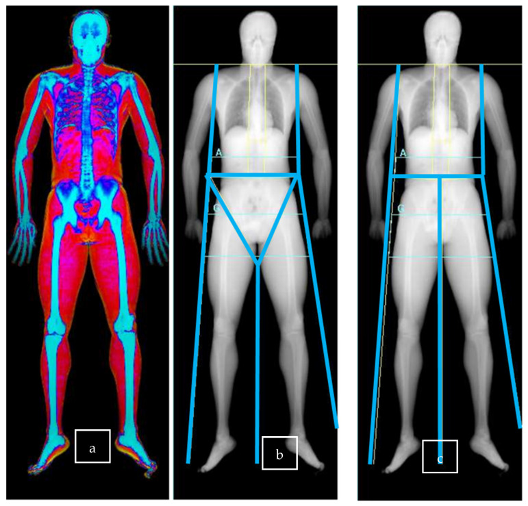 Appendicular Lean Mass Index Using Dual-Energy X-Ray Absorptiometry (DEXA) in Professional Football: A Pilot Study of a New Method for Improved Inter-Operator Reproducibility and Analysis of Pelvi-Trochanteric Muscles.