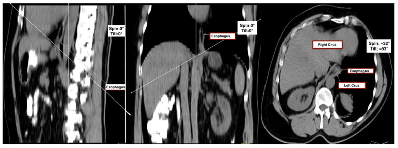 Association Between Thoracic Kyphosis and Hiatal Enlargement: A CT-Based Study Interpreted in Light of GERD-Linked Morphological Markers.