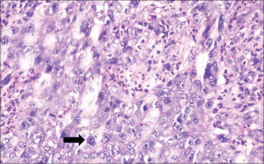 Sinonasal carcinoma: A rare case report.
