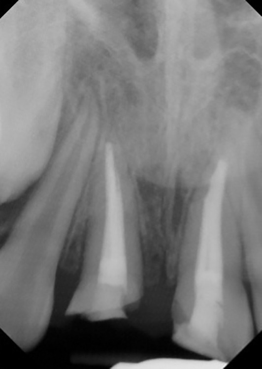 Decoronation: A Conservative Approach Following Dental Trauma in a Pediatric Patient.