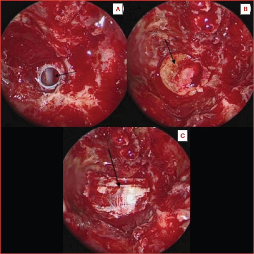 Ecchordosis physaliphora of the clivus: a case series and narrative review of the literature.