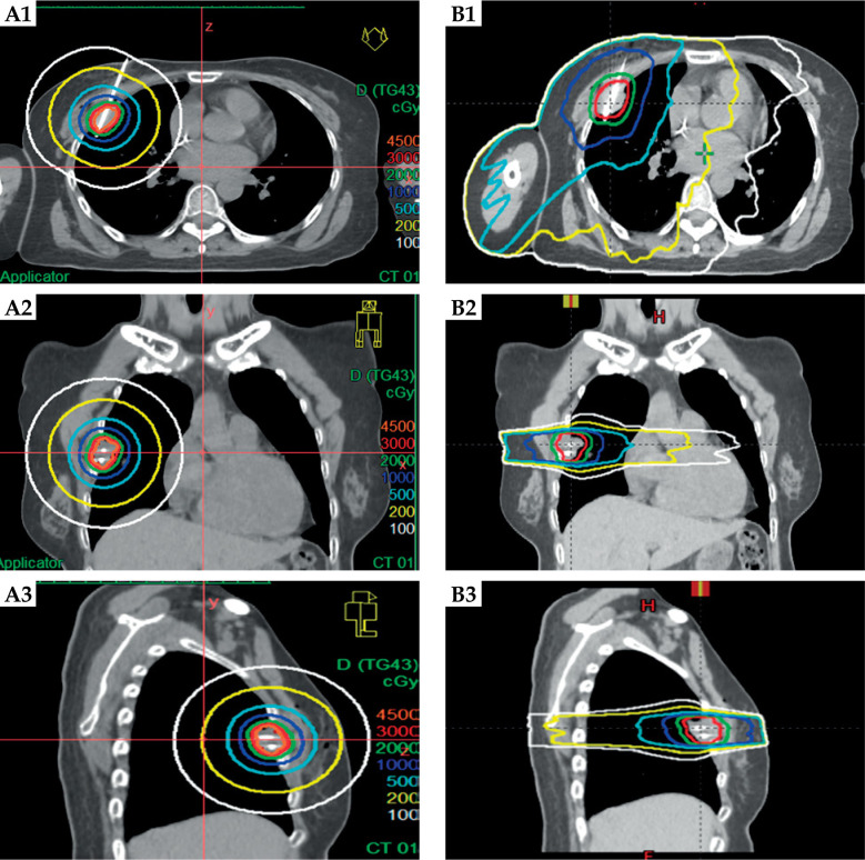 Safety and efficacy of iridium-192 high-dose-rate interstitial brachytherapy for pleural and chest wall tumours: preliminary results.