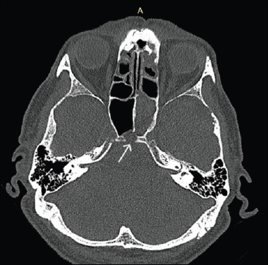 Ecchordosis physaliphora of the clivus: a case series and narrative review of the literature.