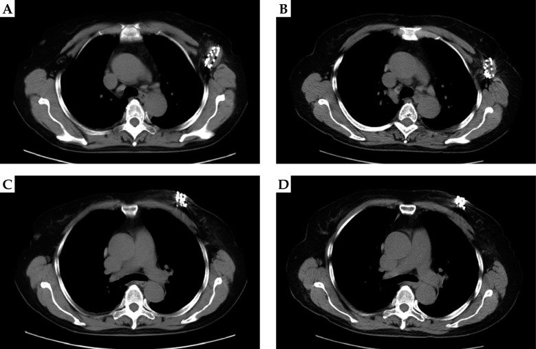 Clinical efficacy of CT-guided iodine-125 seed brachytherapy in unresectable locoregionally recurrent breast cancer.