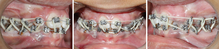 Management of Jaw Fractures in Pediatric Patients Using Orthodontic Appliances: A Case Series.