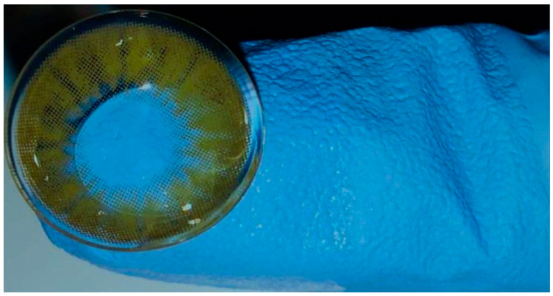 Self-Adhesive, Human Bandage Contact Lens Versus Conjunctival Transposition Flap for Surgical Repair of Feline Corneal Sequestrum.