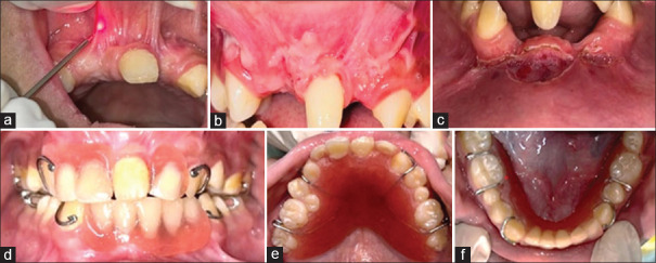 Navigating complexities: A pediatric case of Ellis-van Creveld syndrome.