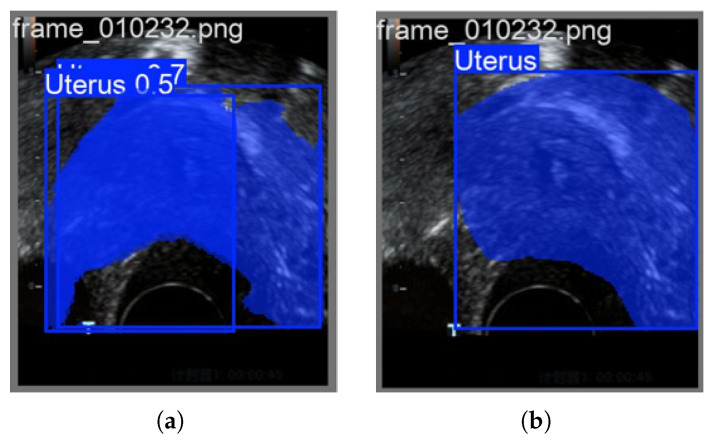 Learning Guided Binary PSO Algorithm for Feature Selection and Reconstruction of Ultrasound Contrast Images in Endometrial Region Detection.