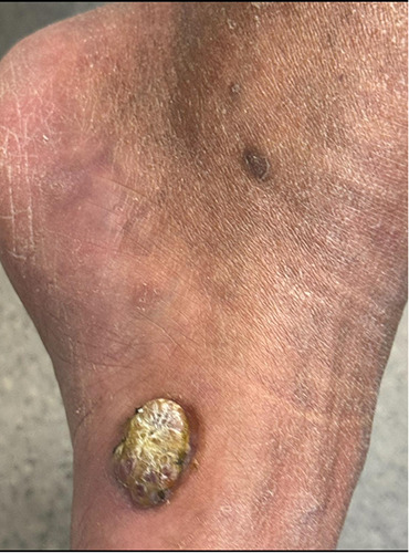 Cutaneous manifestations associated with unknown HIV infection: a case report.