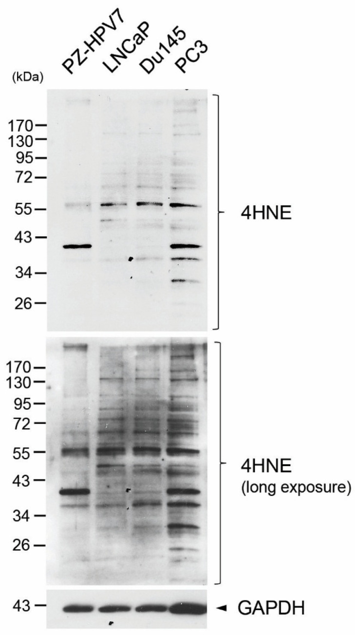 Increased Levels of Oxidative Stress in Human Prostate Intraepithelial Neoplasia and Prostate Cancer: Evidence from 4-Hydroxyneonal Detection and Its Implications.